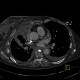Osteoplastic skeletal metastases, breast carcinoma: CT - Computed tomography